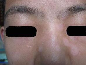 白癜风小瓜可以吃